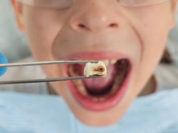 Best Dentist for Tooth Abscess  in Lenexa, KS